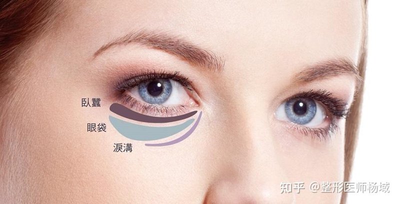 摆脱眼袋困扰,重拾青春光彩——去眼袋方法大揭秘