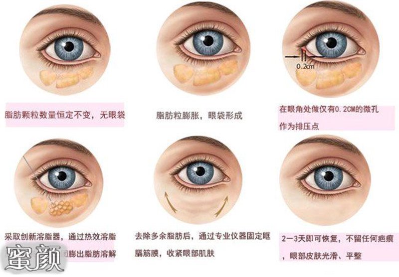 揭秘那些去眼袋的小妙招