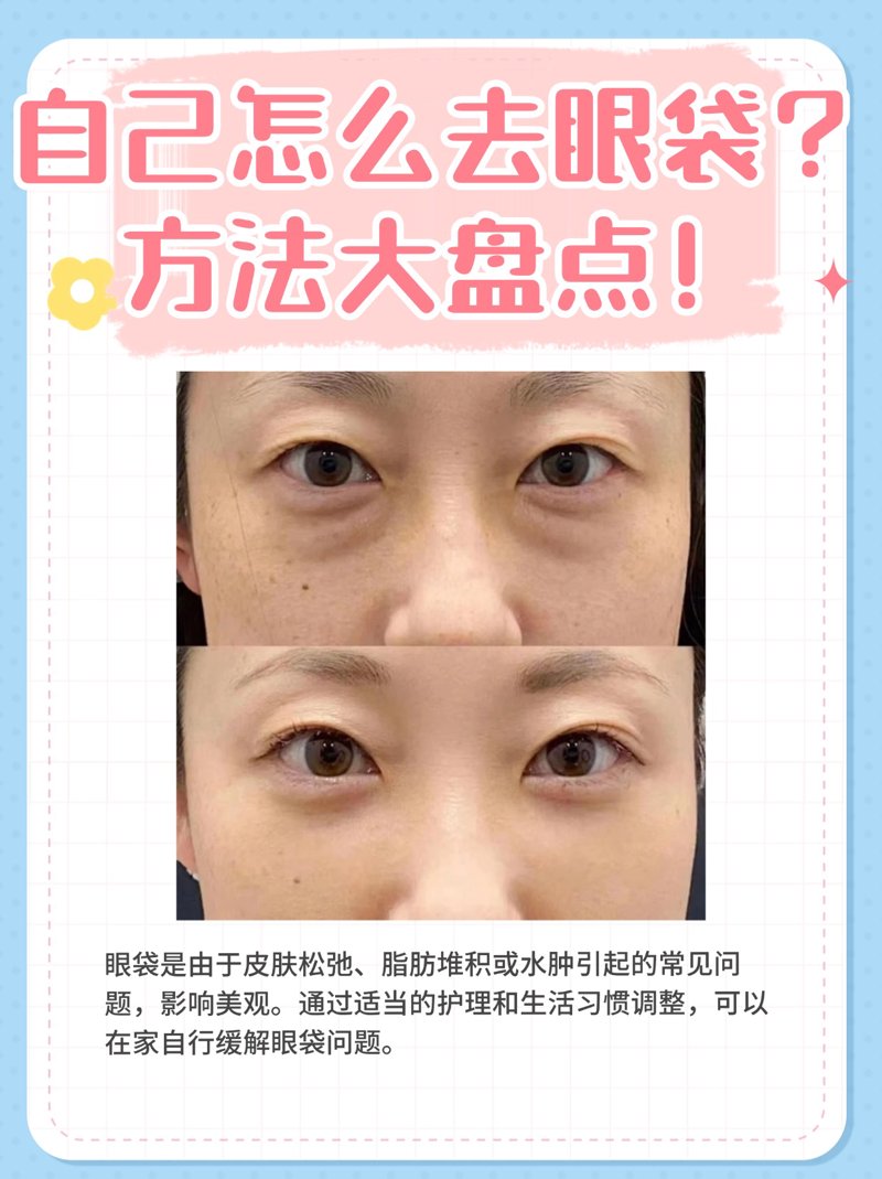 如何有效去除黑眼圈：最新行业动态解析