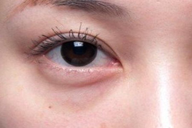 眼袋怎么消除