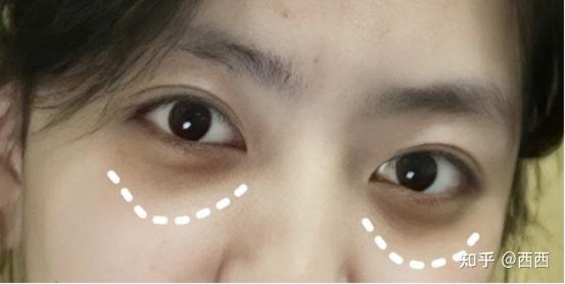 告别眼袋困扰的科学法则