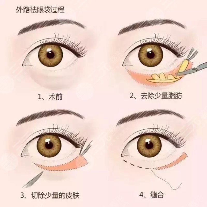 去眼袋小妙招：自然美丽不再是梦
