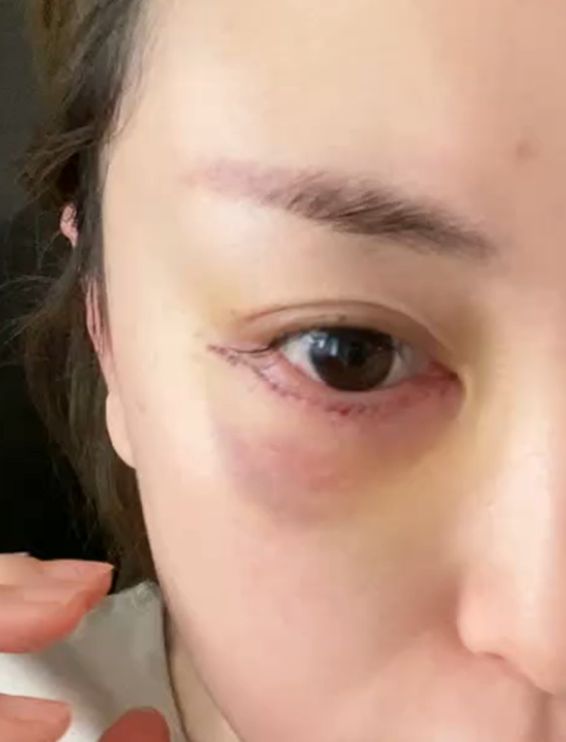 眼袋浮肿的那些事儿：如何有效缓解
