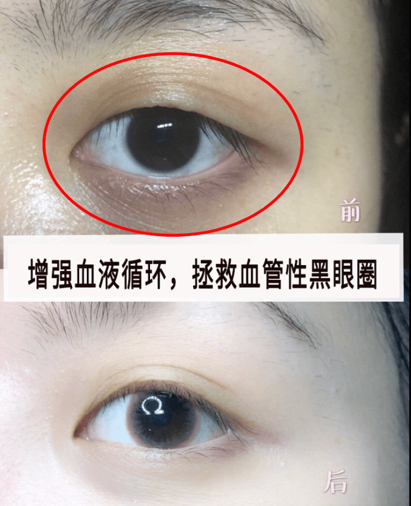 眼袋怎么消除？从日常护理到专业方法的全面解析