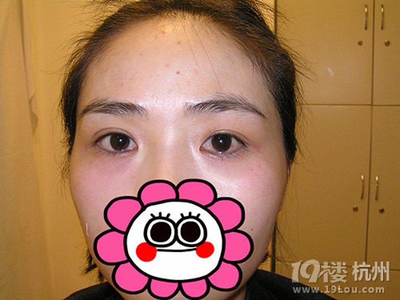 告别眼袋